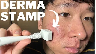 Derma stamp for acne scars. How to get rid of acne scars by microneedling.