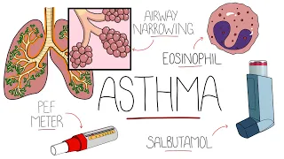 Asthma Explained (Including Pathophysiology)