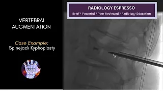 VERTEBRAL AUGMENTATION: Case Example – Spinejack Kyphoplasty