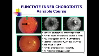 SYM39 11   White Dot Syndromes A Systematic Approach to Diagnosis   Treatment and Prognosis