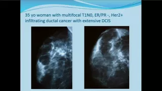 The Myth of Early Detection of Breast Cancer