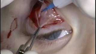 Demonstration of the orbital septum in a pediatric patient