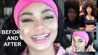 SKIN BLEACHING - BEFORE & AFTER OF SKIN WHITENING AND THE PRODUCTS USED.