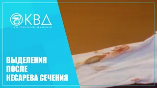 👩 1473  Выделения после кесарева сечения