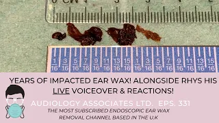 YEARS OF IMPACTED EAR WAX REMOVED - EP331