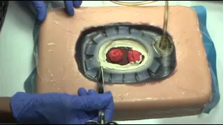 Fistula Solution: Using stoma paste to obtain a seal