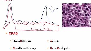 USMLE-Rx Express Video of the Week: Multiple Myeloma