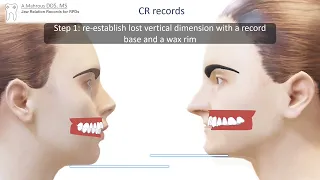 RPD Jaw Relations in 5 mins