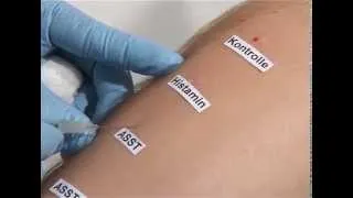 How to make an autologous serum skin test (ASST)
