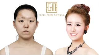 Korean Reconstructive Plastic Surgery Transformation | Seoul Guide Medical