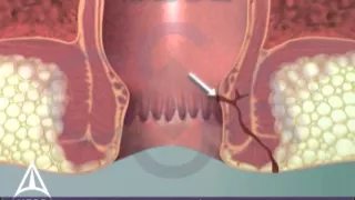 What is a fistula in ano? 3D animation