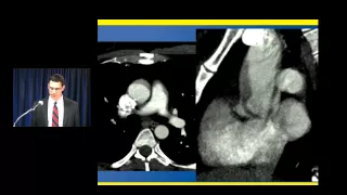 Cardiovascular CT: Common and Uncommon Sources of Misdiagnosis and How to Avoid Them