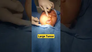 Large Tumor examination before surgery