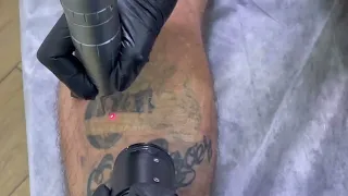 Процесс удаления татуировок