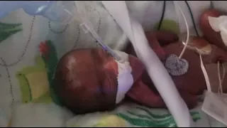 World’s Smallest Baby Born in San Diego at Sharp Mary Birch Hospital