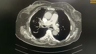 Catheter directed  thrombus aspiration in pulmonary embolism..