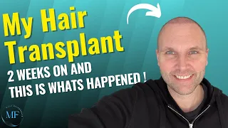 My Hair Transplant 2 Weeks After The Procedure!