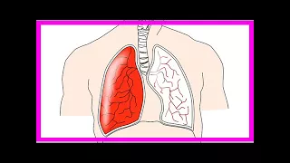 Was ist eine lungenembolie? symptome, ursachen, folgen