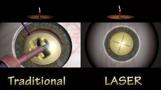 FLACS VS TRADITIONAL CATARACT SURGERY - Nucleus Removal Compare