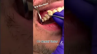 Dental Calculus or dental Tartar, dental Cleaning #tiktok #video #viral #trending #dentist #shorts