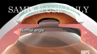 Diagnosis and Treatment of Closed Angle Glaucoma