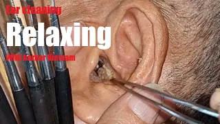 Comfortably relax with earwax removal in Vietnam