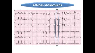 ECG course: Ashman Phenomenon, Dr. Sherif Altoukhy