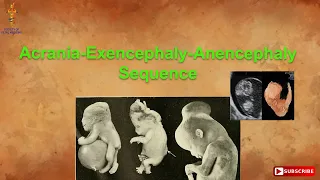 Acrania-Exencephaly-Anencephaly Sequence