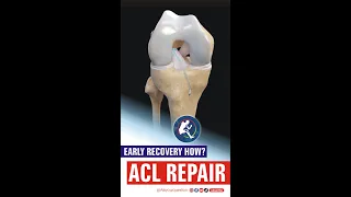 Why ACL Repair Surgery is Essential for Athletes" 💪🏥 @MALIKBINYAMINFANSKABADDIVIBES