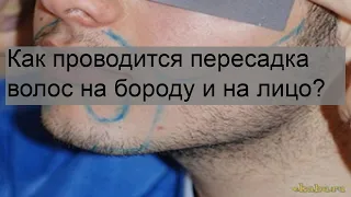 Как проводится пересадка волос на бороду и на лицо?