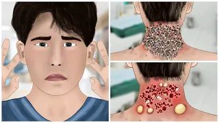 ASMR Removal Maggot Infected & Dog Ticks from head | Severely Injured Animation | Toxic ASMR