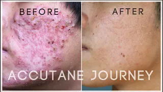 MY ACCUTANE JOURNEY | FROM CYSTIC ACNE TO CLEAR SKIN!
