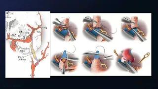 ECA to M2 MCA (ECA-RAG-M2) Interpositional Bypass for Recurrent Fusiform MCA Aneurysm