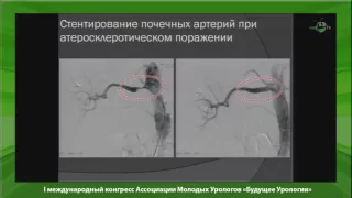 Волков С В - Возможности эндоваскулярной хирургии в урологии