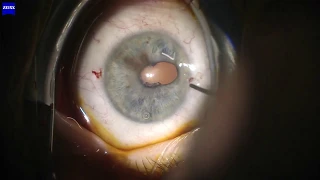 Phaco and AC tap, very small pupil, no retractors