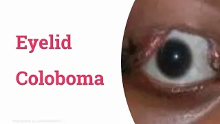 Eyelid Coloboma