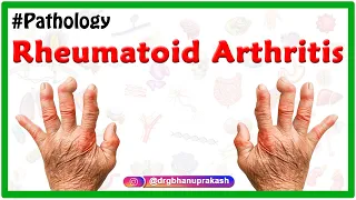 Rheumatoid arthritis Animation - Etiology, Signs and Symptoms, Pathology, Diagnosis, and Treatment