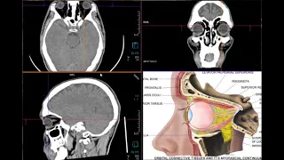 فحص الأشعة المقطعية على حجاج العين بالتفصيل  Orbit CT Scan