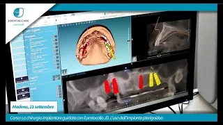 Corso: La chirurgia implantare guidata con il protocollo JD. Impianto Pterigoideo