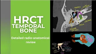 HRCT TEMPORAL BONE- Illustrations and detailed radioanatomy on HRCT. FACIAL NERVE on HRCT T BONE.