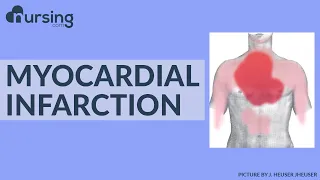 Myocardial Infarction - Lets break this down into simple terms (Nursing School Lesson)