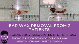 EAR WAX REMOVAL FROM 2 PATIENTS - EP 303