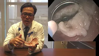 Gastric Per-oral Endoscopic Pyloro-Myotomy (G-POEM) for Gastroparesis - Dr. Ken Chang intro/demo