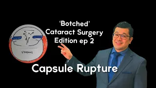 ‘Botched’ Cataract Surgery Edition:  Posterior Capsule Rupture Explained