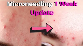 Microneedling Before And After | 1 Week Update