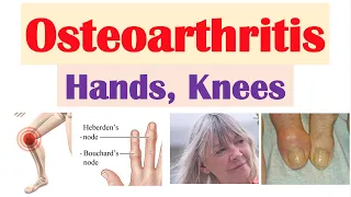 Osteoarthritis (Arthritis of Hands, Knees) | Causes, Risk Factors, Symptoms, Diagnosis, Treatment