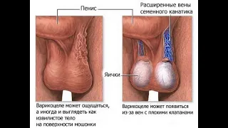 Уругдон веналарини кенгайиши  VARICOCELE  ( ВАРИКОЦЕЛЕ)