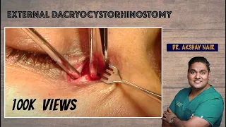 External Dacryocystorhinostomy (DCR)