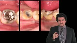 A New Common Sense Approach to Full Mouth Rehabilitation Using Direct Composite -Dr. Ruiz- LSM