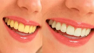 The Best Way To Whiten Teeth In Photoshop  | Photoshop Teeth Whitening Tutorial